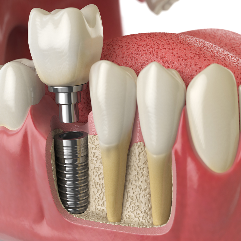 Illustration of a dental implant in the jaw